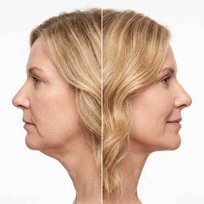 PhotoMed Contour Pro - 04 before after