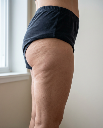 Before — soft uneven thigh skin